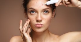 5 dažniausios aknės varginamos odos priežiūros klaidos