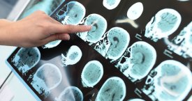 Mokslininkai nustebę: atskleidė, kas turi didesnę riziką susirgti Alzheimeriu