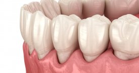 Dažniausia dantų netekimo priežastis: dėl šios ligos kreipiasi vis jaunesni pacientai