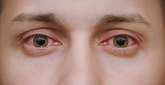 4 dažniausiai pasitaikančios akių ligos ir kaip jų išvengti