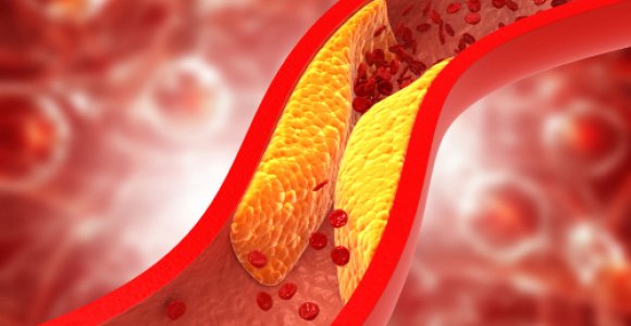 Sukluskite: šie 6 ženklai išduoda aukštą cholesterolio kiekį kraujyje